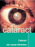 Cataract (B.Inggeris)