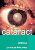 Cataract (B.Inggeris)