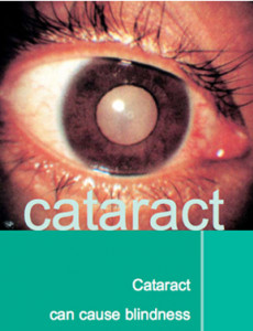 Cataract (B.Inggeris)