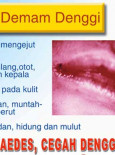 Denggi:Slaid TV Denggi 03 (BM)