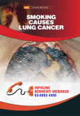 Merokok Penyebab Kanser Paru-paru (B. Inggeris)