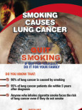 Merokok penyebab kanser paru-paru (BI)