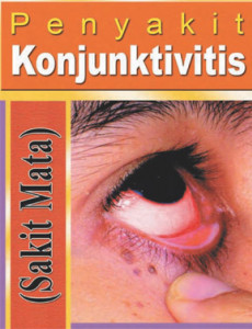 Konjunktivitis