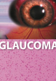Glaukoma (B.Inggeris)