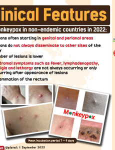 Monkey Pox : Clinical Features